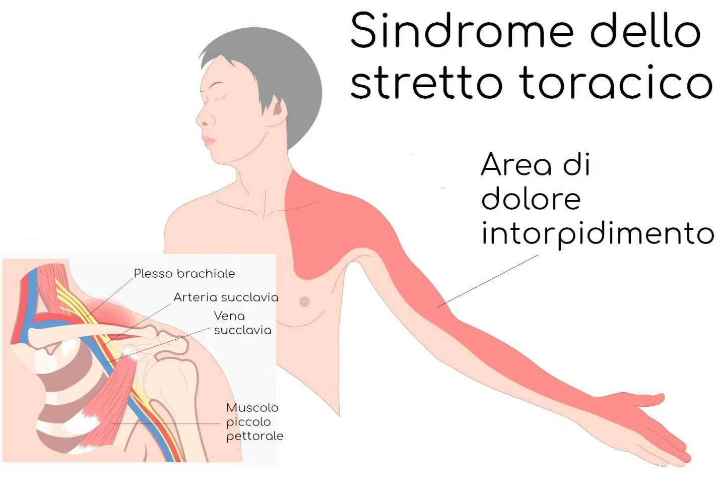 Sindrome dello Stretto Toracico