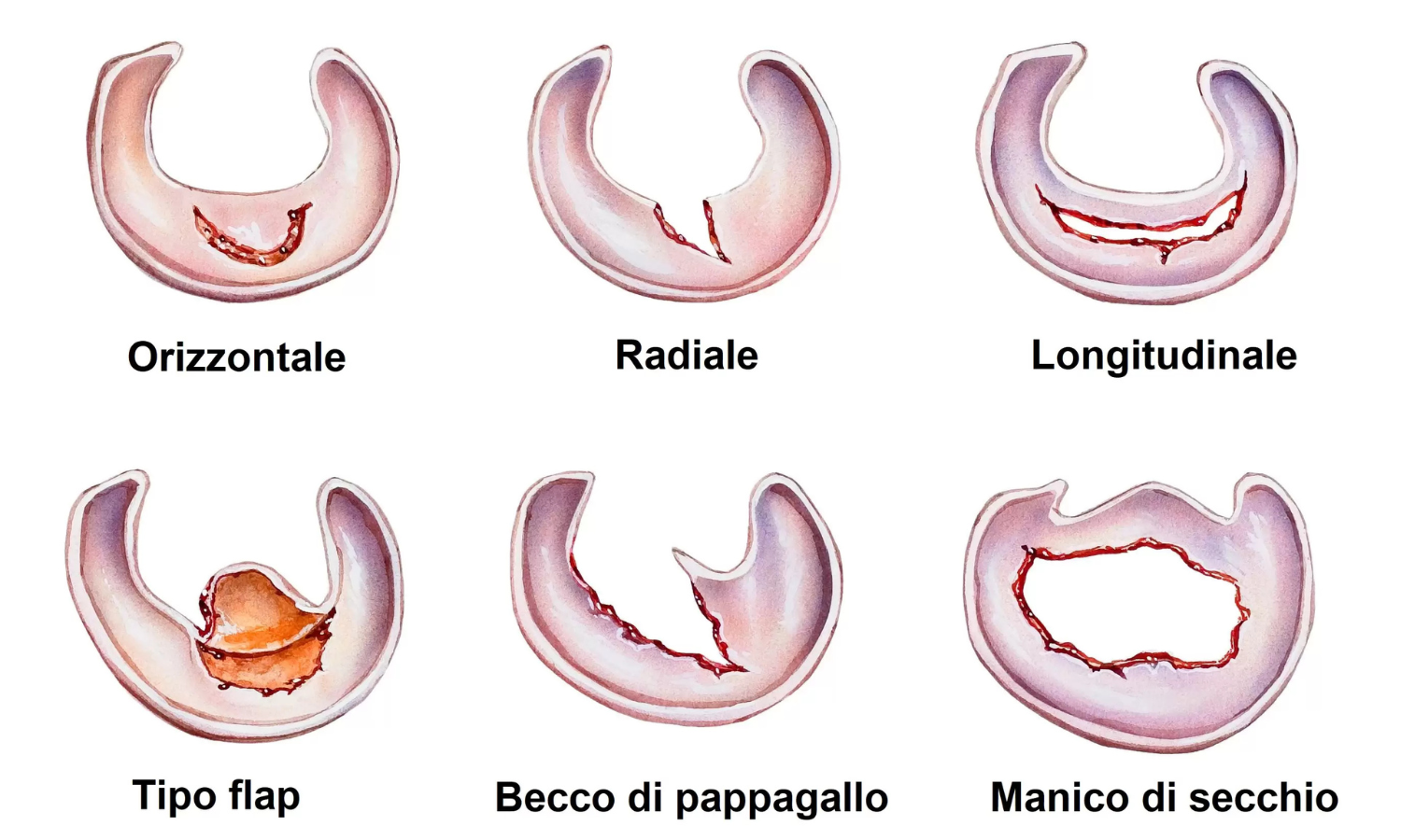 tipologie-nomi-lesioni-meniscali